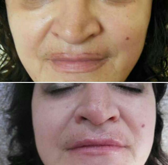 Eliminacion de tatuajes y micropigmentación en BCN