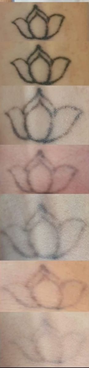 Eliminacion de tatuajes y micropigmentación en BCN