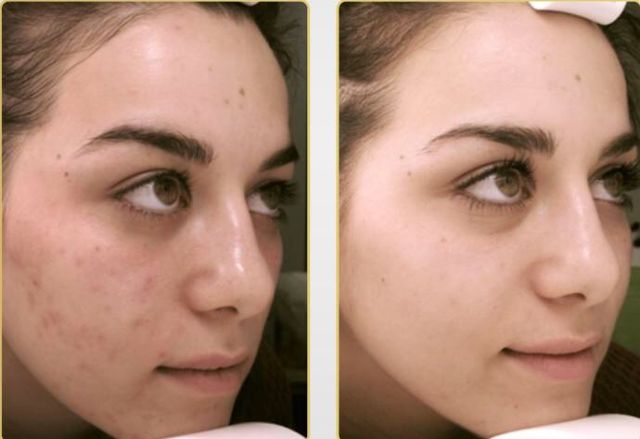 Real Bb Glow Antes Y Después