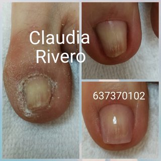 Reconstrucción uñas pies Sevilla Pedicura spa