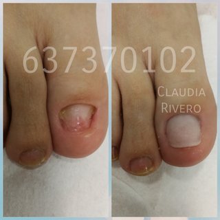 Reconstrucción uñas pies Sevilla Pedicura spa