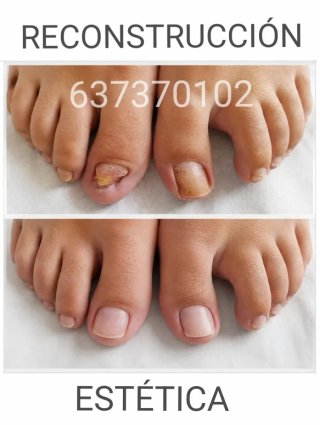 Reconstrucción uñas pies Sevilla Pedicura spa