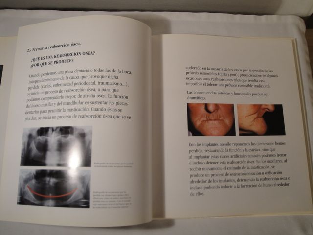 Los implantes.Dr. Eduardo Anitua Aldecoa.Año 1994