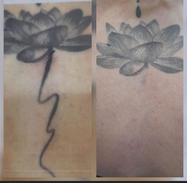 eliminacion de TATUAJES