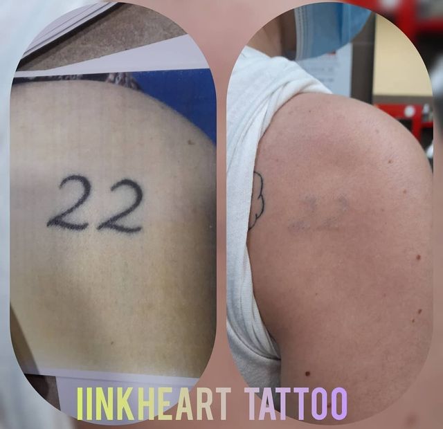 eliminacion de TATUAJES