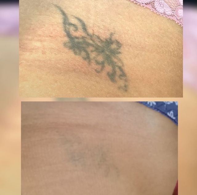 eliminacion de TATUAJES