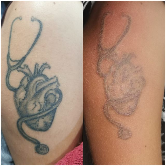 eliminacion de TATUAJES