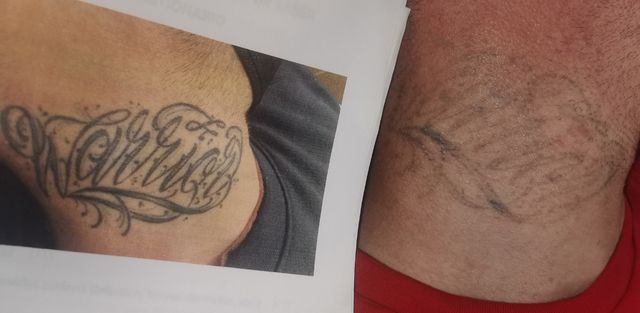 eliminacion de TATUAJES