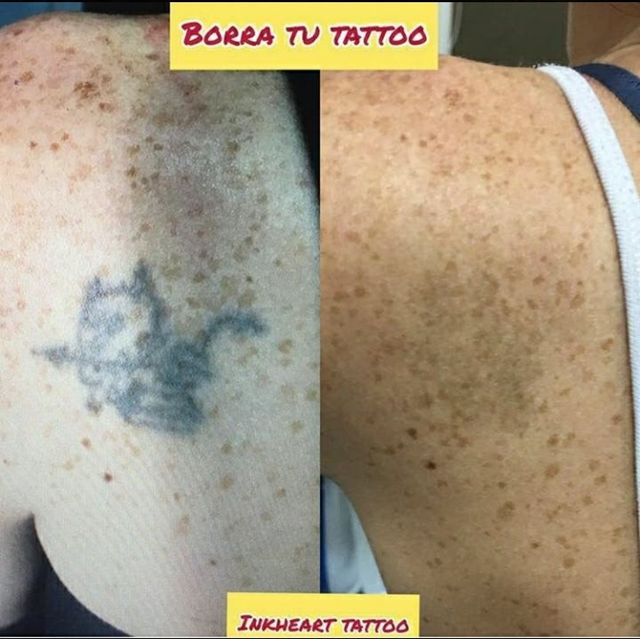 eliminacion de tatuajes, tatuajes y mas...