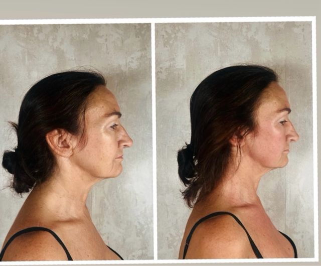 Masaje facial antiarrugas Marbella