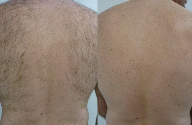 DEPILACIÓN CORPORAL A DOMICILIO