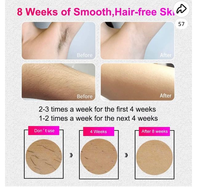 Epilatore laser professionale 