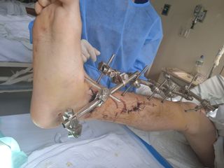 Fisioterapia y rehabilitación a domicilio
