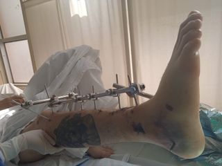 Fisioterapia y rehabilitación a domicilio