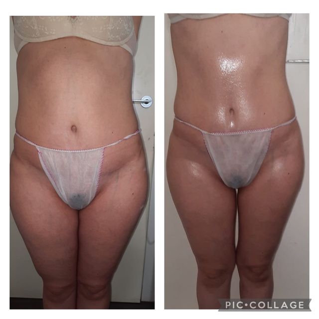 Tratamiento reductores