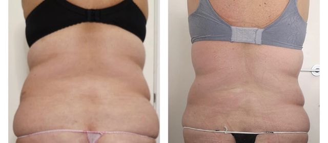 Tratamiento reductores