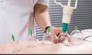 Hijama tradicional