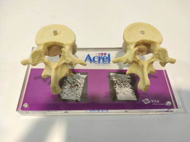 Expositor médico de osteoporose