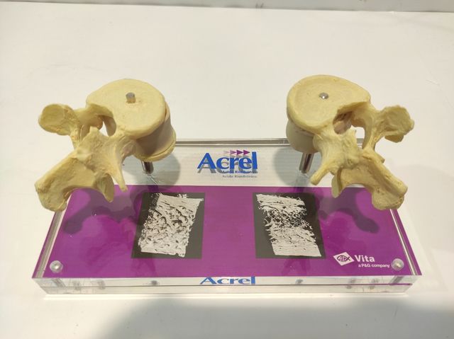 Expositor médico de osteoporose