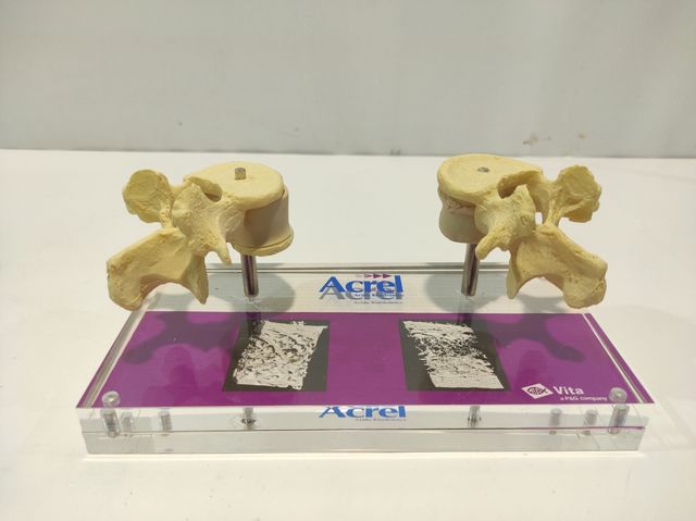 Expositor médico de osteoporose