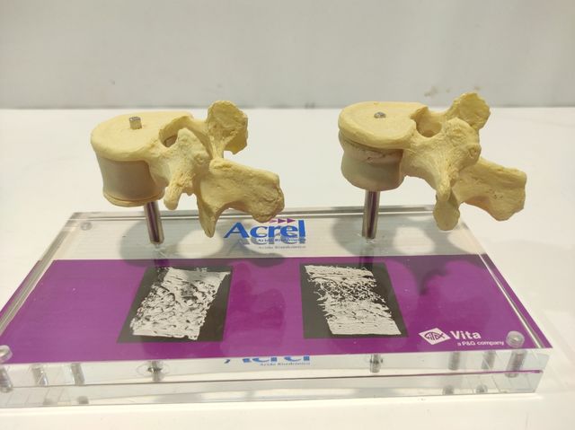 Expositor médico de osteoporose