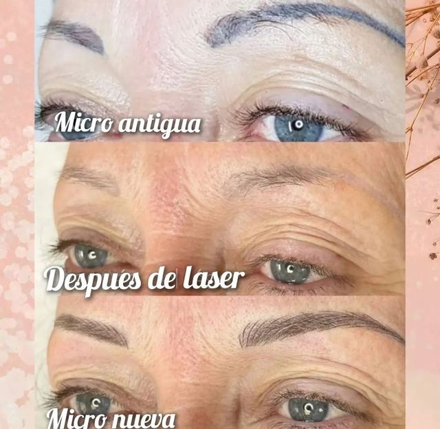 Eliminación de microblading