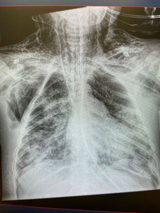 Fisioterapia respiratoria