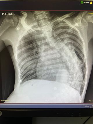Fisioterapia respiratoria