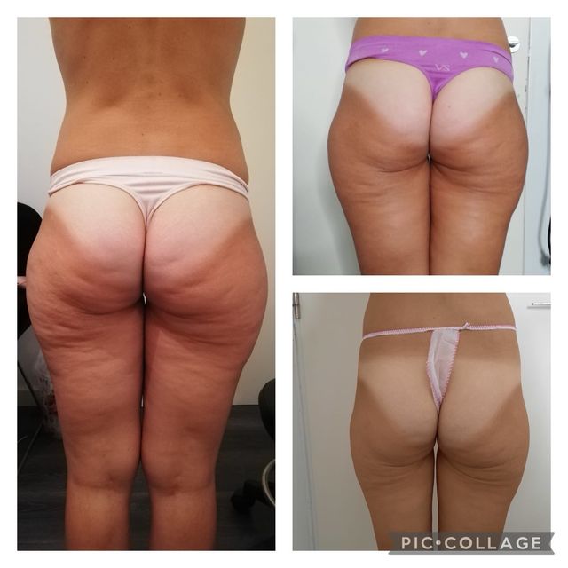 tratamienro reductor