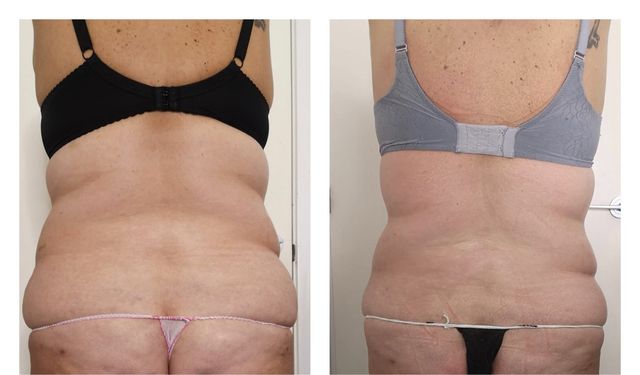 tratamienro reductor