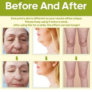 Radiofrecuencia Facial