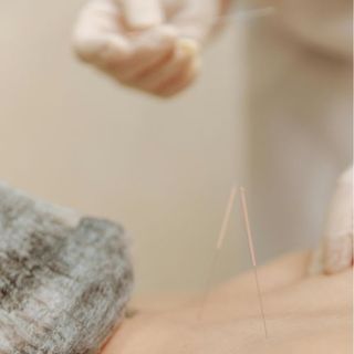 Medicina Integrativa/ Acupuntura