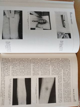 Tuberculosis pulmonar libro antiguo