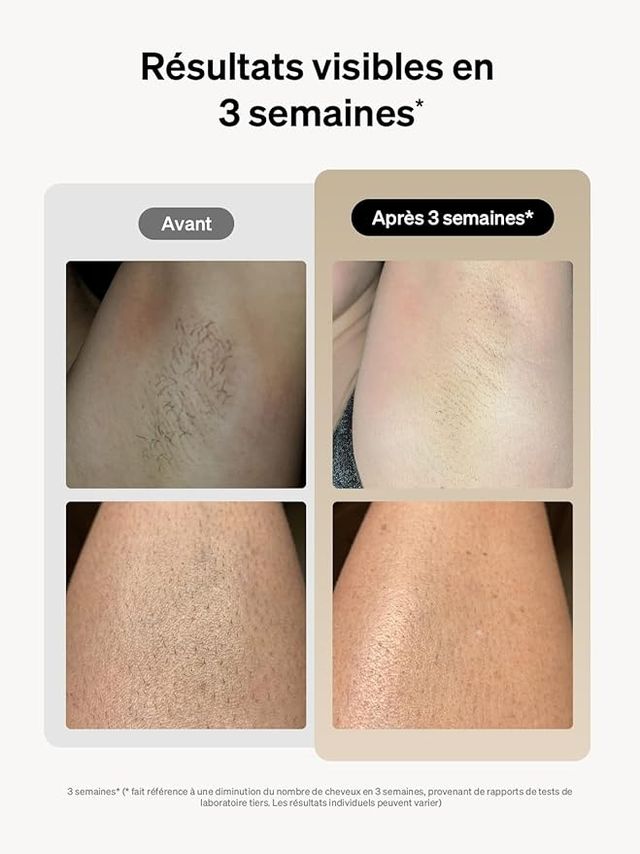 Ulike Air 3 Depilación láser luz pulsada