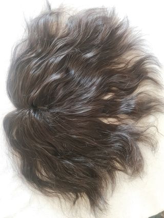 Fabrico de prótesis frontal