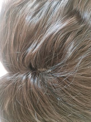 Fabrico de prótesis frontal