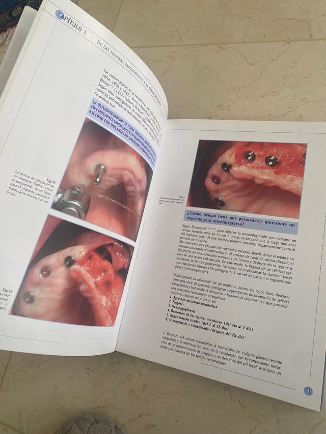Libro la carga inmediata en implantología Mozzati