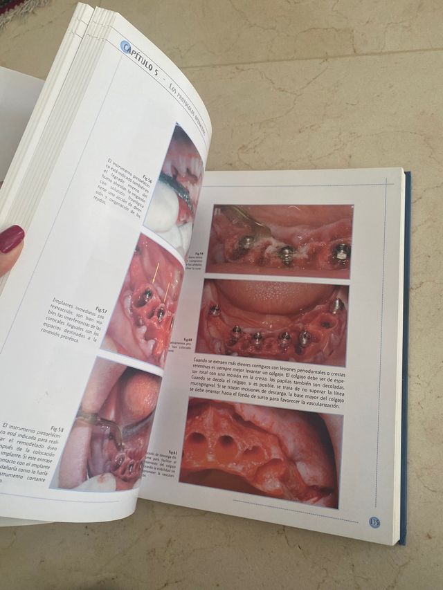 Libro la carga inmediata en implantología Mozzati