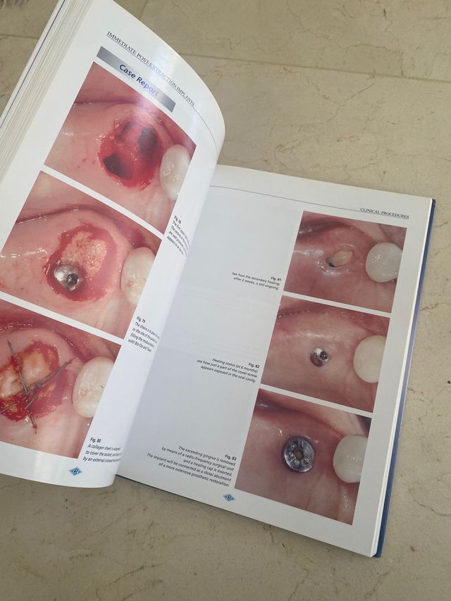 Libro immediate implant extraction Corrente