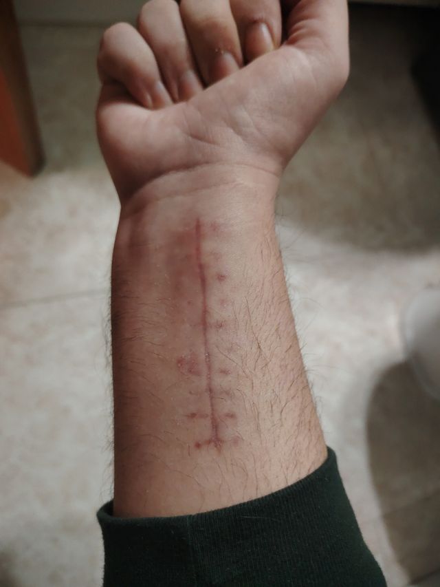 Férula muñeca derecha.