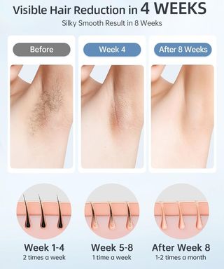 Depiladora Laser 3 en 1