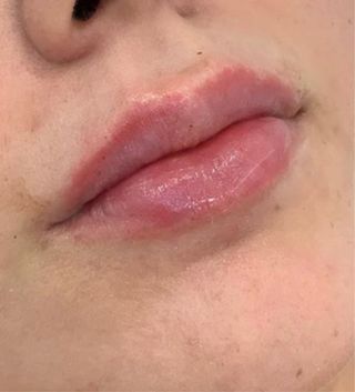 Relleno e hidratación de labios