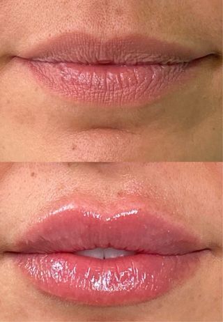 Relleno e hidratación de labios