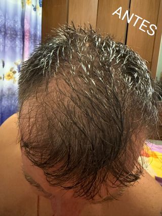 LOCIÓN ANTICAIDA NATURAL VEGANA