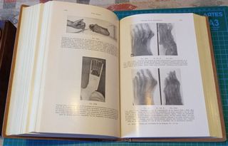 Técnica del tratamiento de las fracturas.