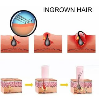 Gorro de terapia para caida