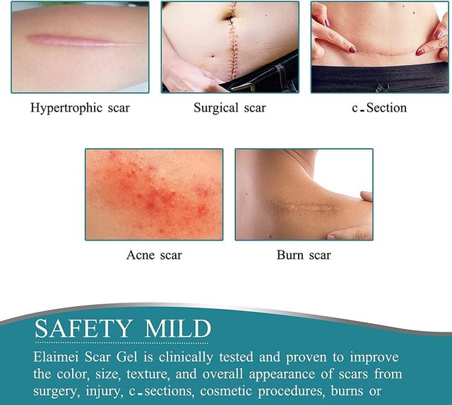 Foglie di silicone per cicatrici - ELAIMEI