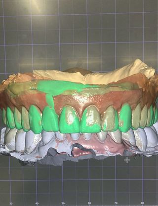 Diseñador Exocad Exocad