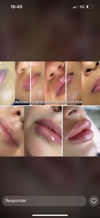 #Micropigmentación #labios | Hyaluron Pen