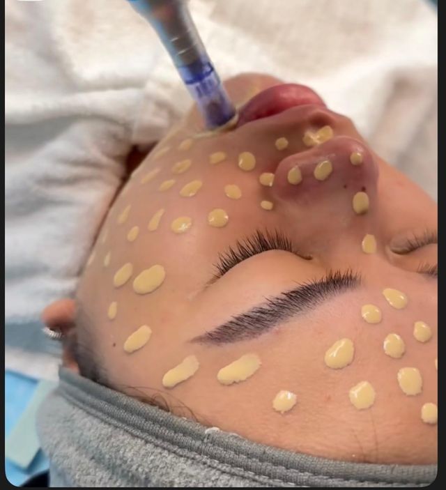 Cuidado facial: Dermapen, Baby Glow